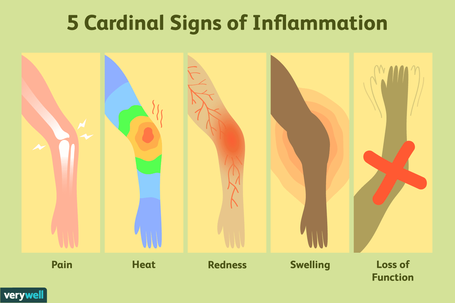Inflammation and Nutrition: 5 Cardinal Signs of Inflammation