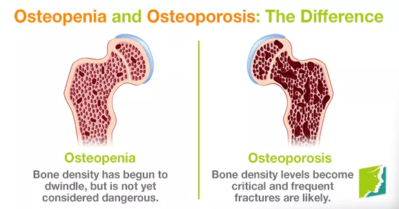 Bone Density & Exercise: Diagram of the difference between osteopenia and osteoporosis.
